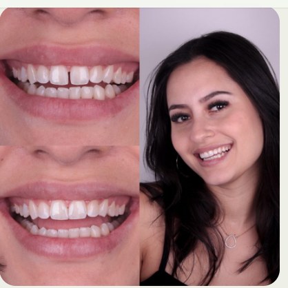 Facetas em resina, Dra. Zaine Dias, Hortolândia