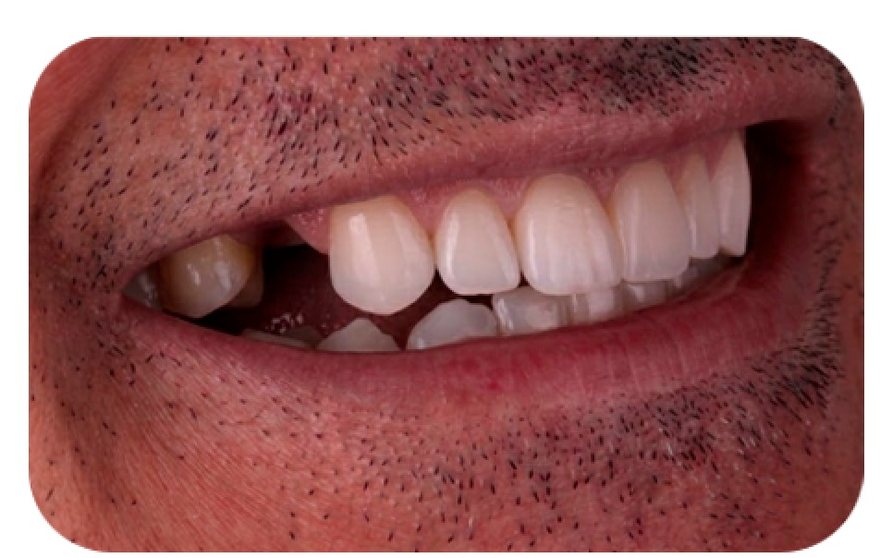 Implante dentário e planejamento radiográfico, Dra. Zaine Dias, Hortolândia