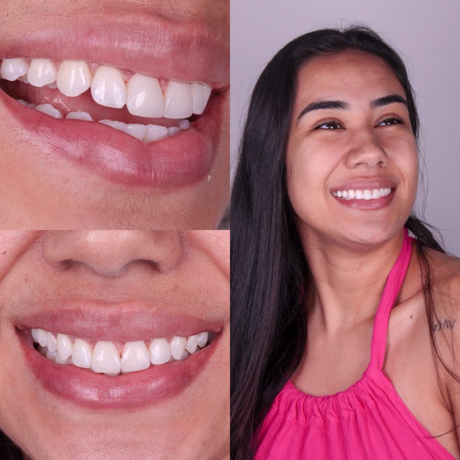 Reabilitação estética do sorriso com facetas, Dra. Zaine Dias, Hortolândia