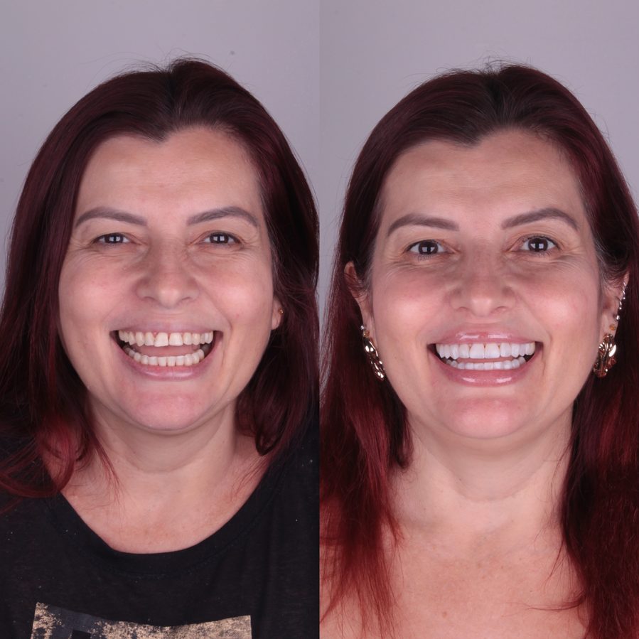 Harmonização do sorriso, caso clínico, Dra. Zaine Dias, Hortolândia