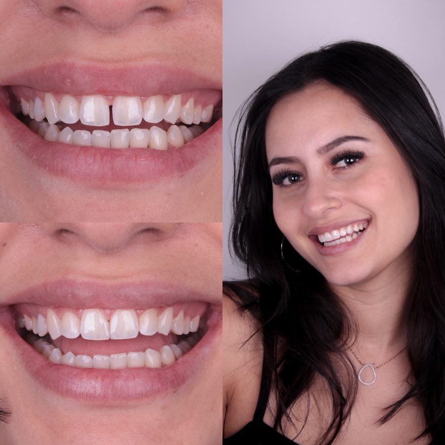 Facetas anteriores, trabalho realizado na clínica, Dra. Zaine Dias, Hortolândia