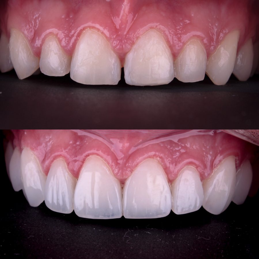 Fechamento de espaços com facetas, Dra. Zaine Dias, Hortolândia