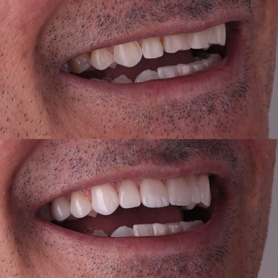 Reabilitação do sorriso, caso clínico, Dra. Zaine Dias, Hortolândia