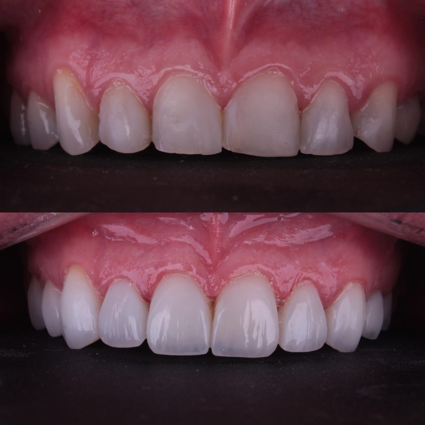 Facetas em porcelana, antes e depois, Dra. Zaine Dias, Hortolândia