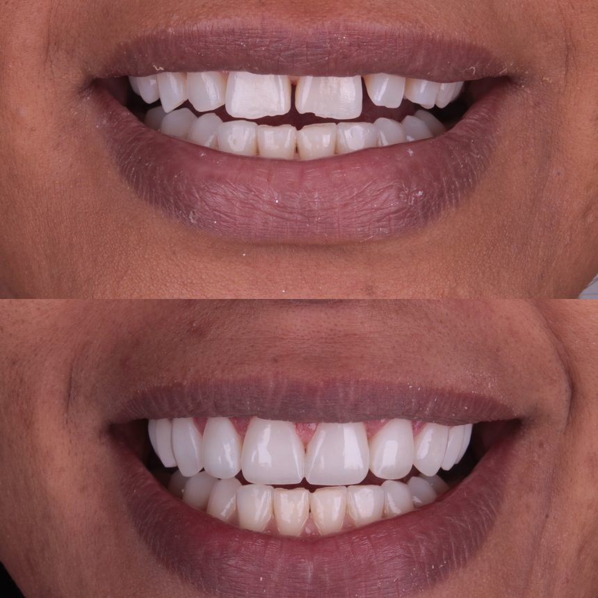 Reabilitação estética, antes e depois, Dra. Zaine Dias, Hortolândia