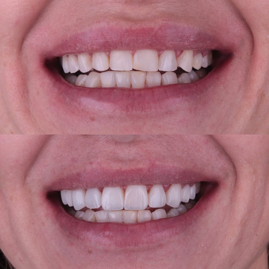 Lentes de contato dental, antes e depois, Dra. Zaine Dias, Hortolândia