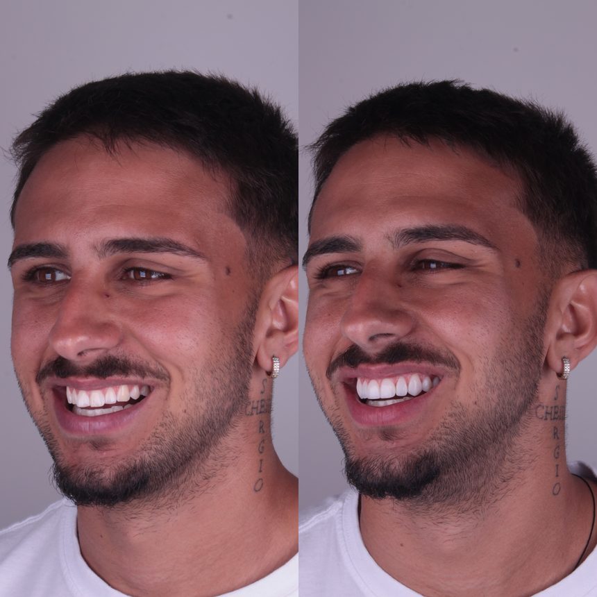 Reabilitação do sorriso, antes e depois, Dra. Zaine Dias, Hortolândia