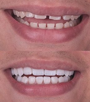 Lentes de contato dental, antes e depois, Dra. Zaine Dias, Hortolândia