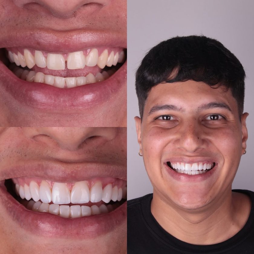 Reabilitação estética, antes e depois, Dra. Zaine Dias, Hortolândia