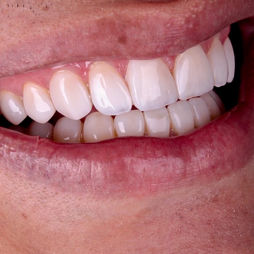 Facetas em porcelana, antes e depois, Dra. Zaine Dias, Hortolândia