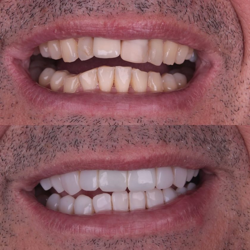 Fechamento de diastema com facetas, antes e depois, Dra. Zaine Dias, Hortolândia