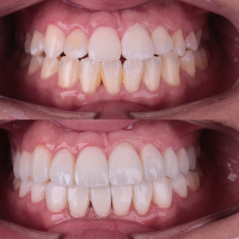 Clareamento e reabilitação, antes e depois, Dra. Zaine Dias, Hortolândia