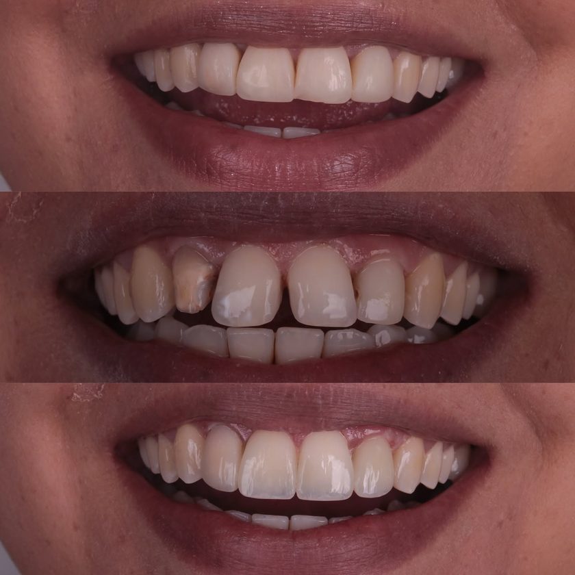 Reabilitação do sorriso, antes e depois, Dra. Zaine Dias, Hortolândia